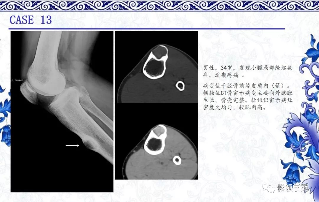 【经典】骨性纤维结构不良的影像表现及鉴别