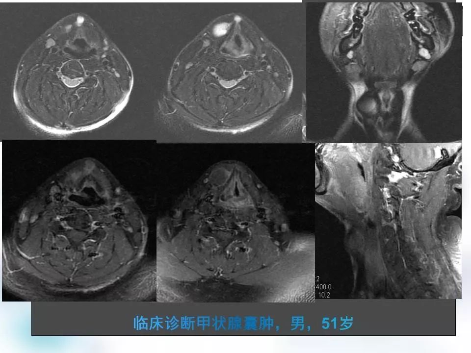 颈部常见先天发育性囊肿影像天地