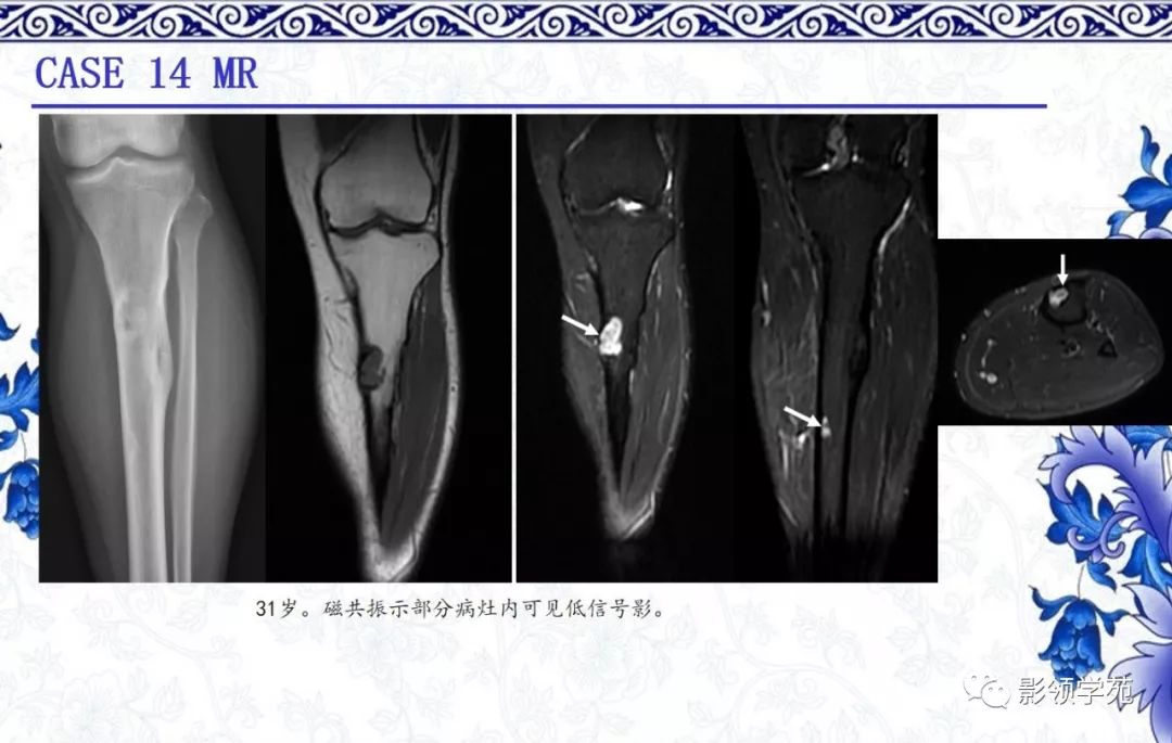 经典骨性纤维结构不良的影像表现及鉴别