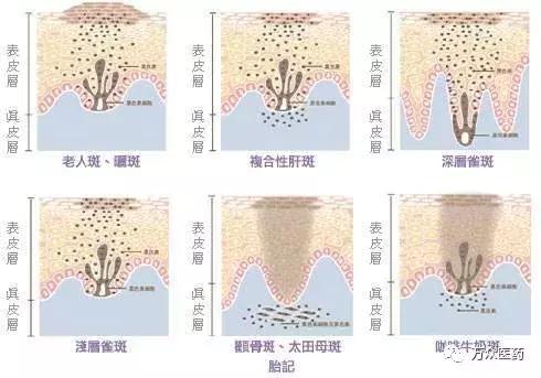 手上起老年斑怎么办