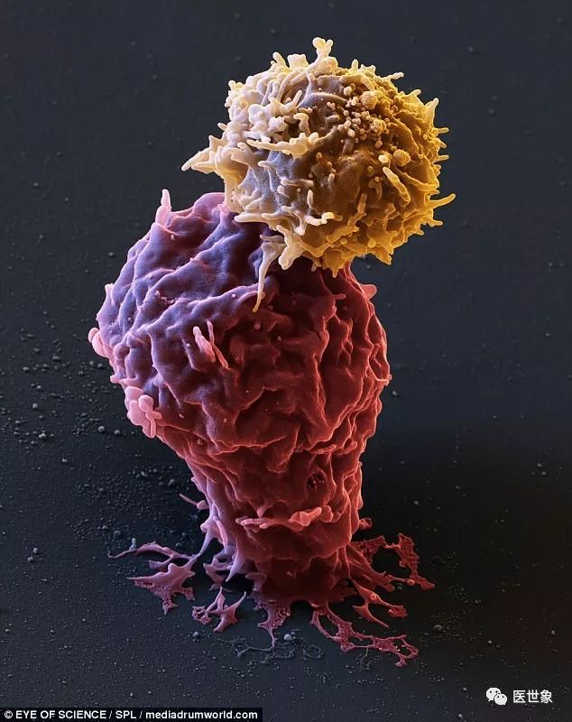 CAR-T细胞与癌细胞搏斗的场景