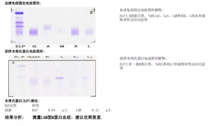 233 免疫固定电泳:微量lam型m蛋白特殊检查:骨髓流式细胞分析:异常