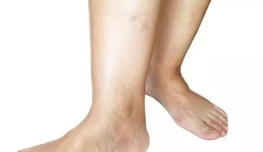 大腿外侧出现赘肉说明胆经出现於堵,肝胆相表里,会引起女士火气旺.