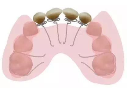 上颌颌垫活动矫治器 简单点说,就是喊你把这个上颌颌垫活动矫治器