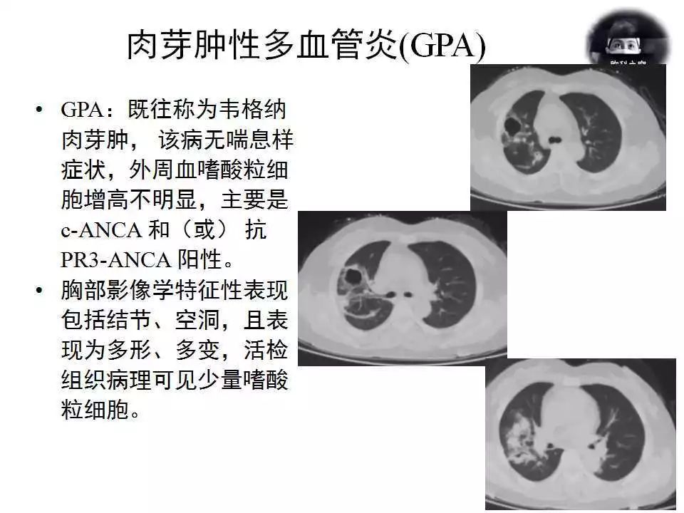 238期轮值病例嗜酸性肉芽肿性多血管炎