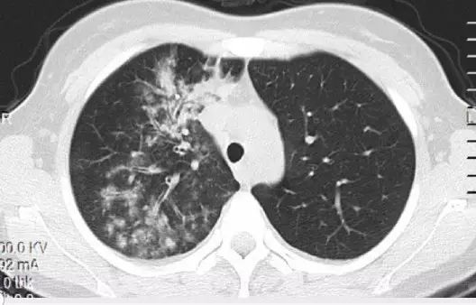 【温故知新】一句话总结肺部感染的影像诊断!