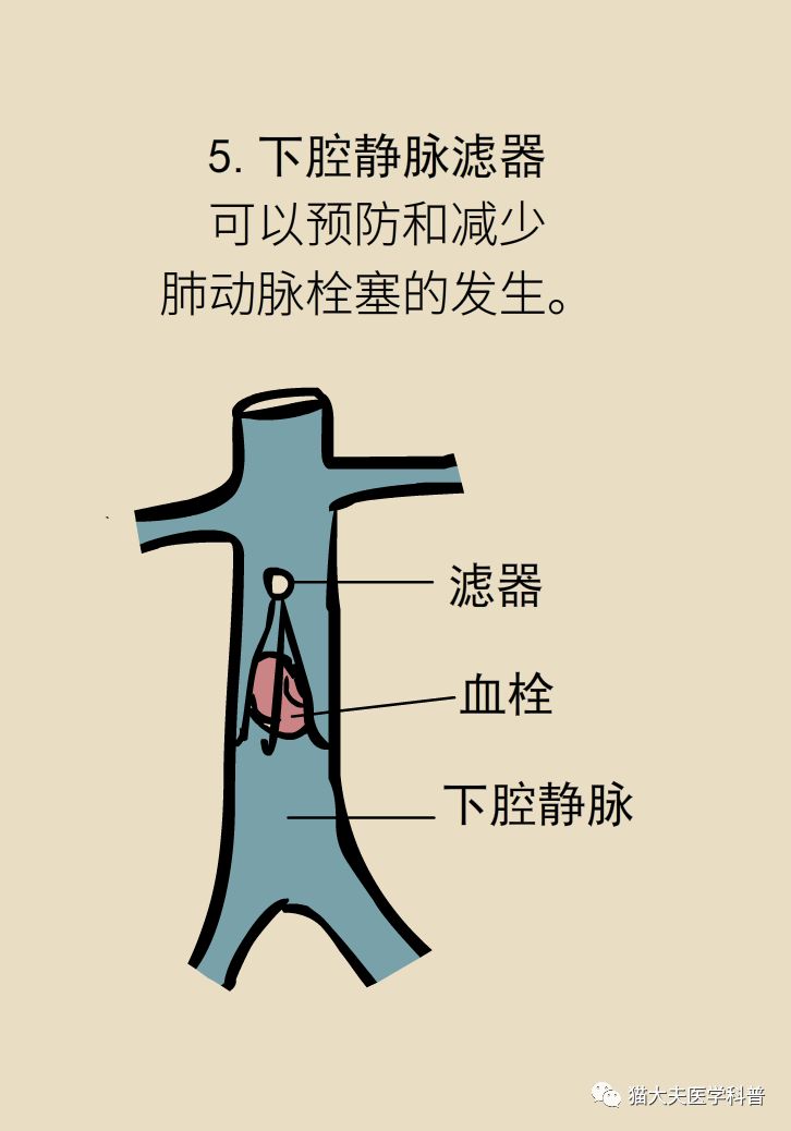 崴脚12天后肺栓塞离世深静脉血栓几大高危因素你中招了吗