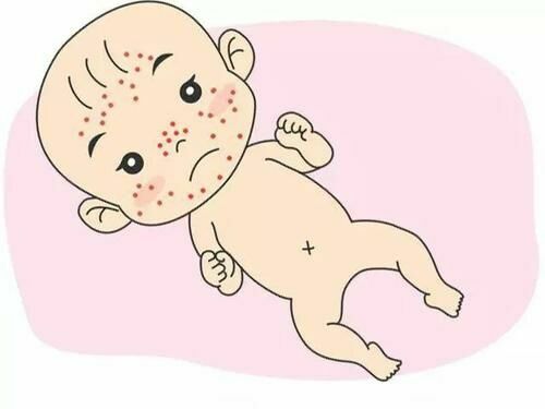 原创如何辨别新生儿皮肤上的是湿疹还是痤疮?