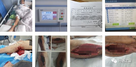 连江一老人不幸遭遇车祸大腿断裂腿部多处肌肉开裂伤势严重现急需您的