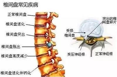 圣草康古贴:腰椎间盘突出症的人快看,后悔现在才知道!