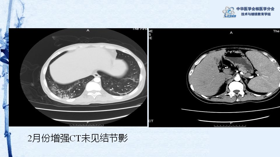 【病例】49期:程兵 | pet/ct显像诊断淋巴瘤相关噬血细胞综合征一例