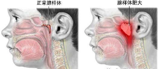 腺样体肥大系腺样体因炎症的反复刺激而发生病理性增生,从而引起鼻塞