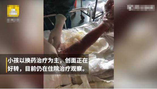                     2岁女童翻进170度油锅，哭声撕心裂肺，随后妈妈竟活剥一层皮