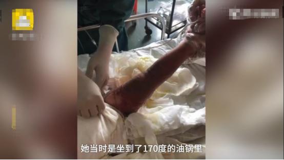                     2岁女童翻进170度油锅，哭声撕心裂肺，随后妈妈竟活剥一层皮
