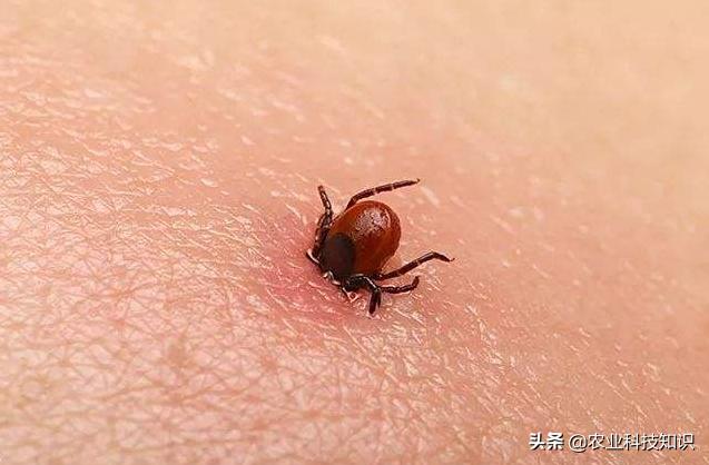 蜱虫叮咬进皮肤