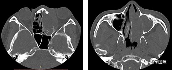 鼻窦ct平扫 骨窗