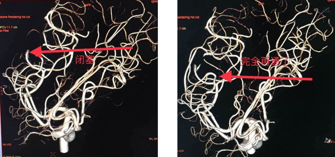 从3d 图像可以更清楚显示取栓前后大脑中动脉远端分支闭塞和再通的