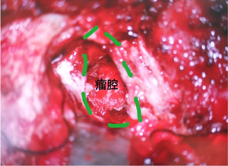 【8月7日】卜博 | 枕下极外侧入路处理舌下神经管周围