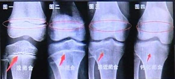 15岁男孩身高1.5m骨骺线闭合，检查结果和这习惯有关，妈妈很自责