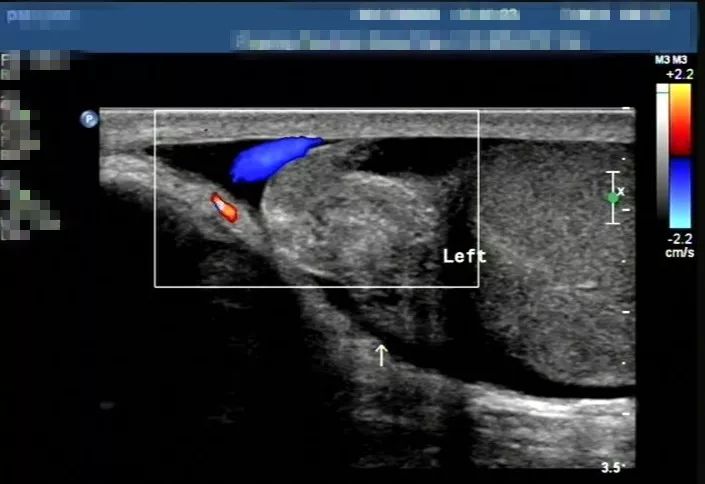 超声检查中看到的睾丸扭转