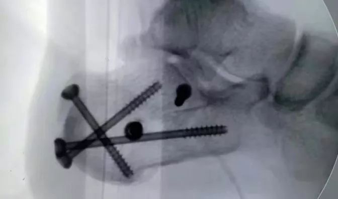 高难度跟骨粉碎性骨折,用"它"来治疗～_手术