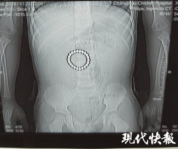                     三岁娃吞下22颗磁力珠，胃肠变成筛子