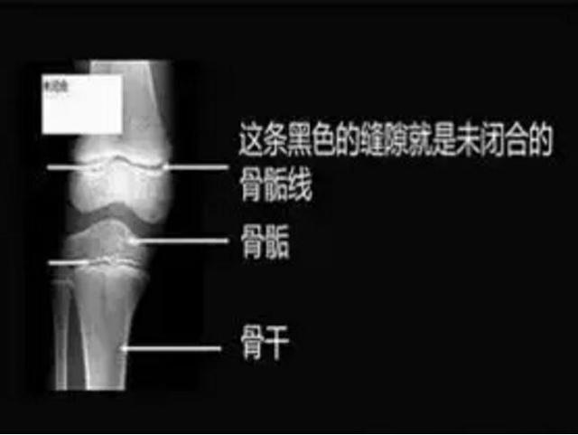 15岁男孩身高1.5m骨骺线闭合，检查结果和这习惯有关，妈妈很自责