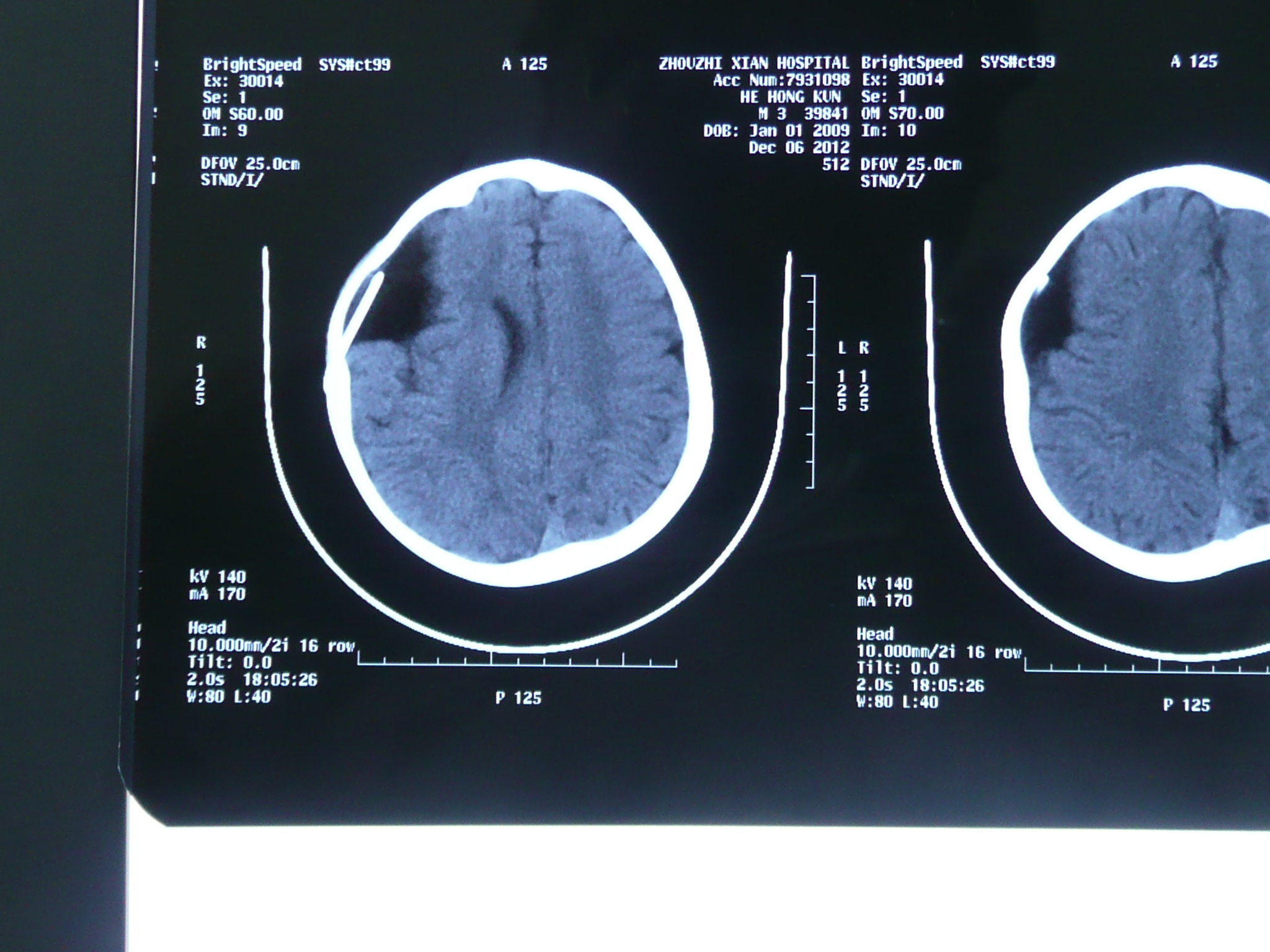 贺晓生教授脑室巨大脑膜瘤全切术案例_肿瘤