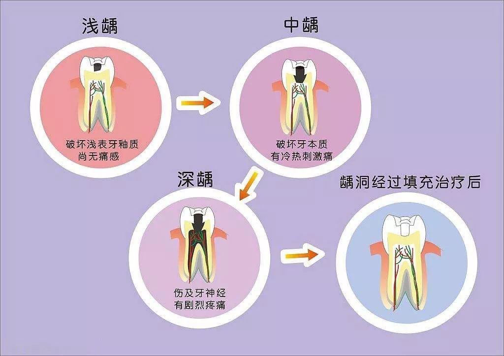 龋齿的病变一般要经历浅龋,中龋,深龋三个过程 浅龋阶段,尚无疼痛感