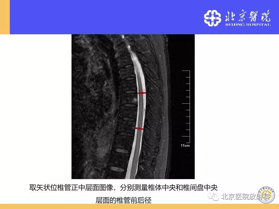 专题讲座-椎管狭窄的影像学检查