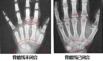 15岁男孩身高1.5m骨骺线闭合，检查结果和这习惯有关，妈妈很自责
