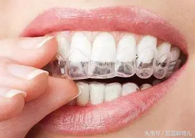 带牙套,我一生中最正确最不后悔的决定