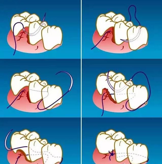 牙医必备牙周治疗缝针缝线选择和缝合方法