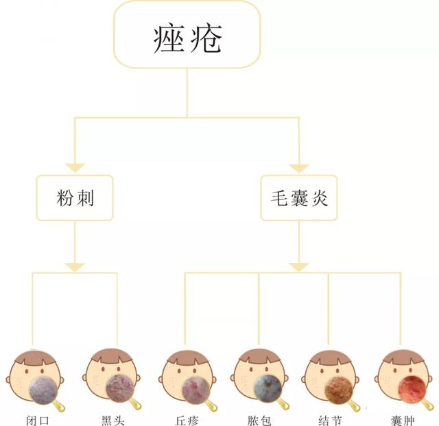 痘痘的学称叫作痤疮,痤疮分为多种.祛痘,先要了解自己的肌肤情况!