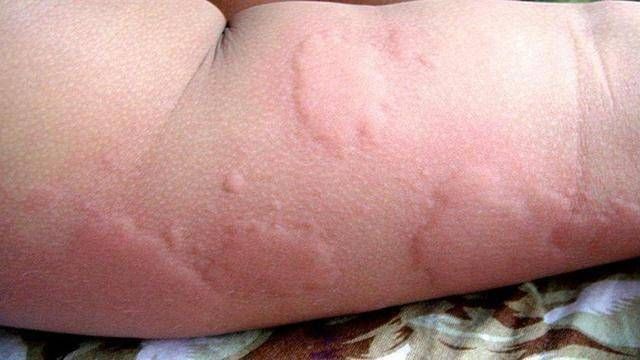                     宝宝疹子老不好，多半是你总拒绝这个药