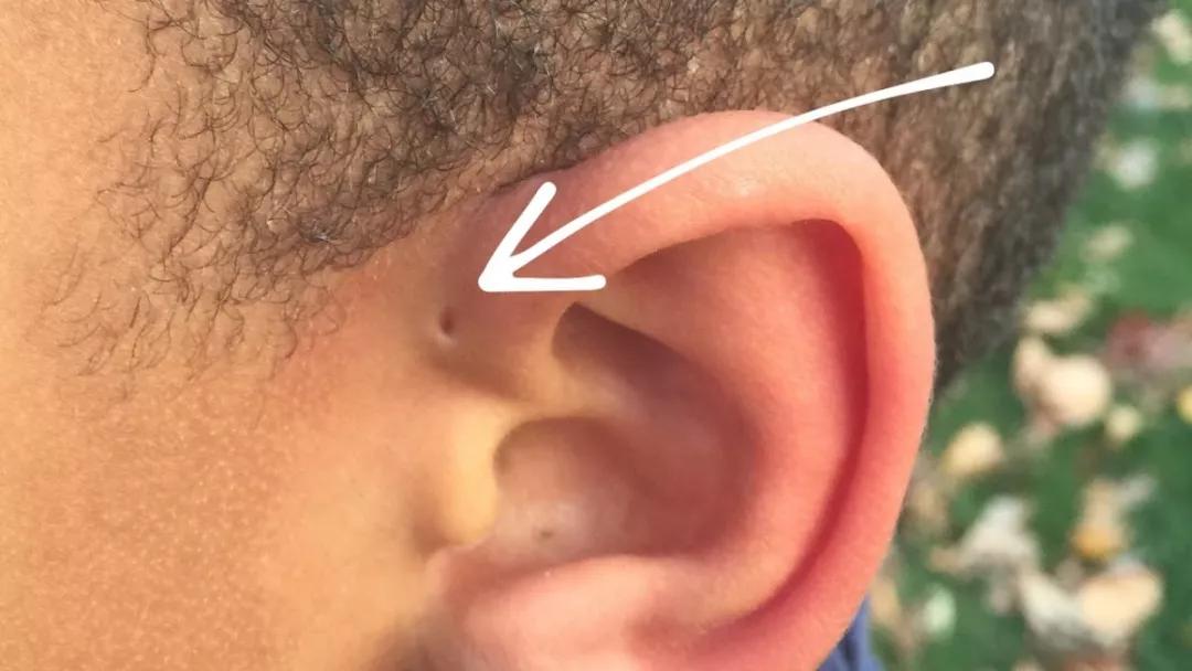 但其实,这个洞在医学上叫做 "耳前瘘管",是一种常见的先天畸形.