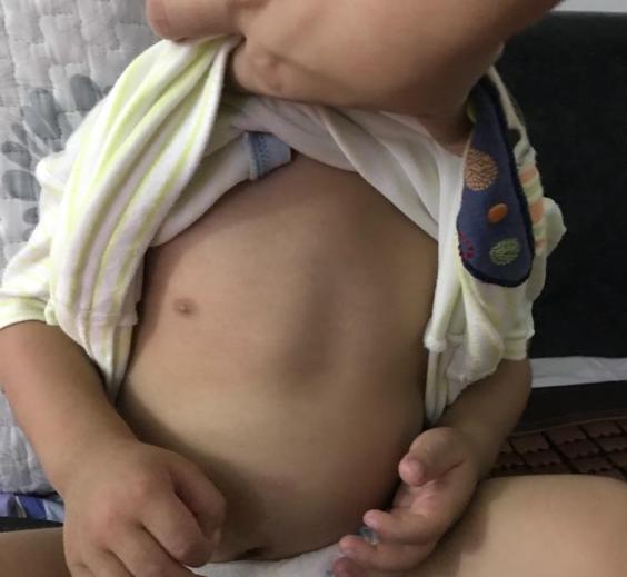                     “鸡胸”的孩子，一年比一年多！都怪家长不重视，可不能这样