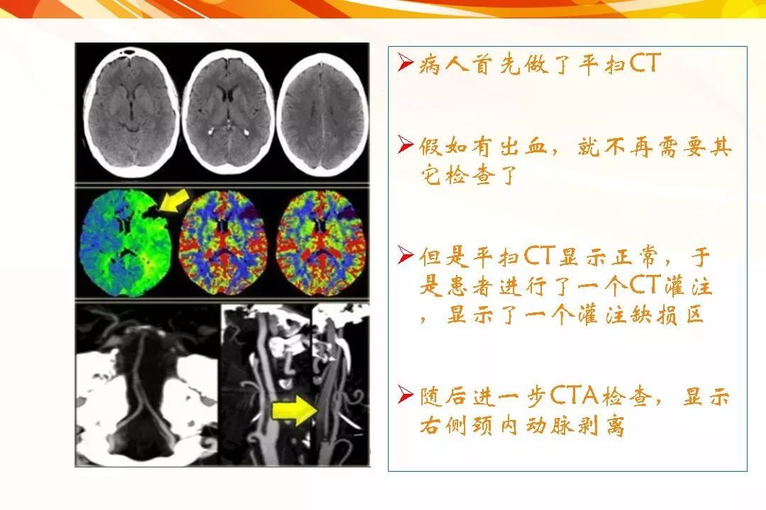 脑缺血—急性脑梗死的影像学表现 | 影像天地