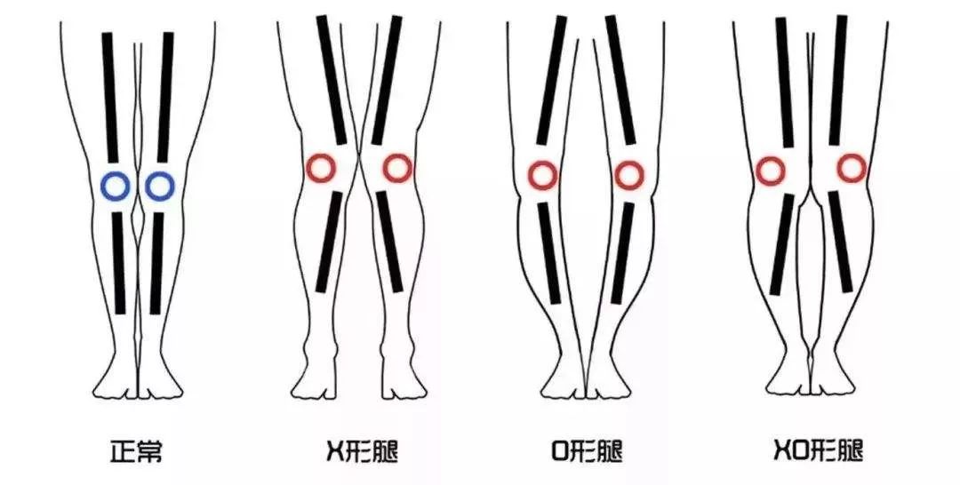 x,o,xo形腿示意图