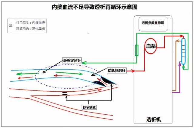 医生护士我的内瘘血流量不足是怎么回事呢