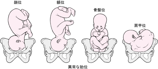 还有一种不能入盆的姿势就是横位,横位的情况下,胎头要么在左腹部要