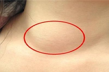 什么原因会引起淋巴肿瘤 950b6582cd304b628695c2b15e36a6af.jpeg