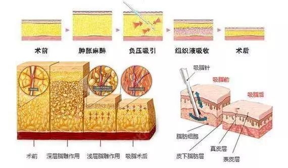 脂肪是怎么消失的 98d99fca0c294aa4b3bcc4d36ed37915.jpeg