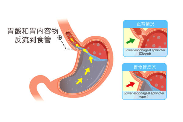 打嗝想吐怎么办