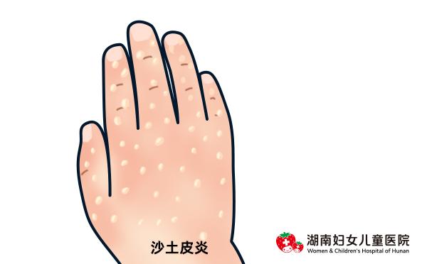 中医认为夏季炎热,小儿体内蕴有湿热,有些儿童天生不耐受水,肥皂,沙土