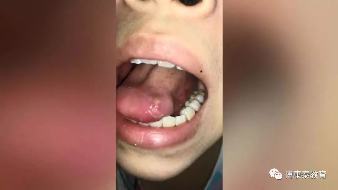 小女孩补牙舌头被割破,缝了8针!牙医该怎么赔?