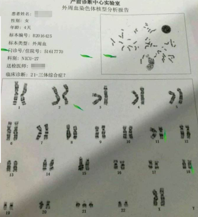 又称先天愚型或down综合征,是由染色体异常(多了一条21号染色体)而