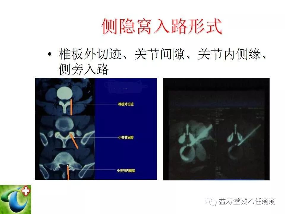 侧隐窝,椎间孔注射等临床实用技术