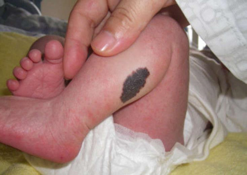 胎记在医学上被称为"母斑"或"痣",当皮肤组织在发育时发生异常的增生