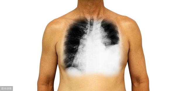 肺部积水严重嘛 3419a8407ccb4d31923cebf065c6d231.jpeg